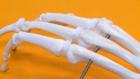 Thumbnail image for Bio Implants To Offer Cure for Arthritis